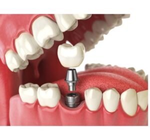 Dental implant