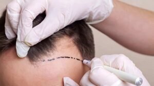 DHI vs FUE: Which Hair Transplant Technique Is Right for You?